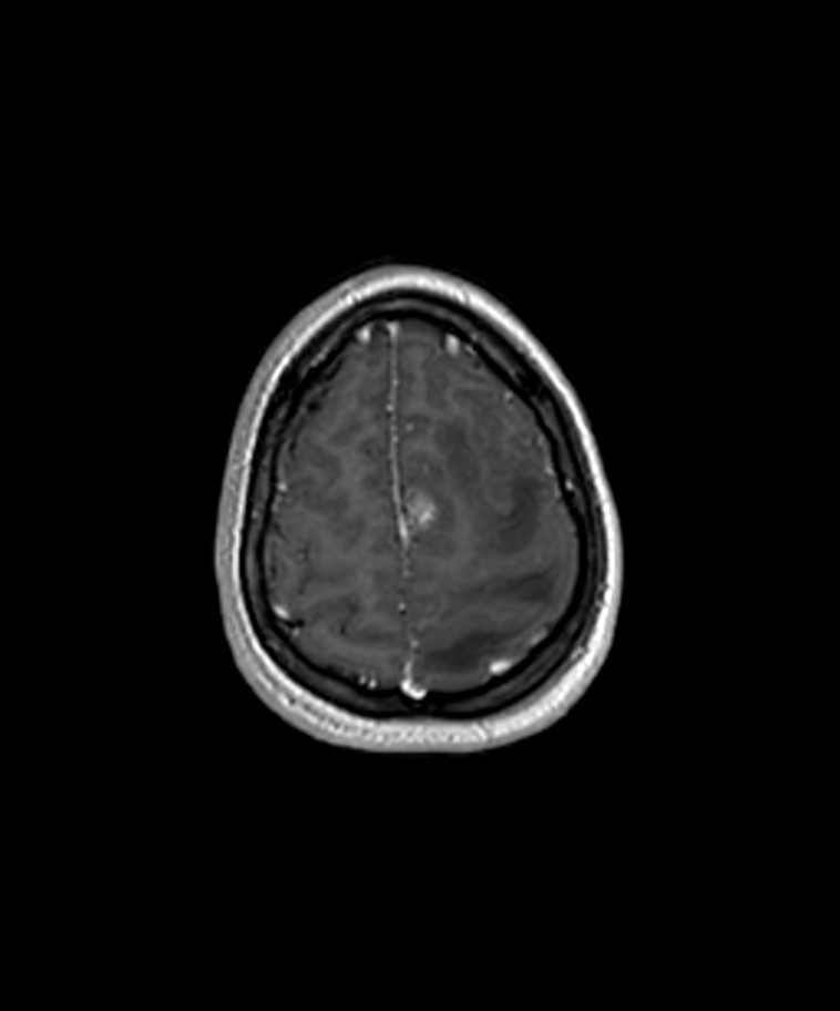 Angiomatous meningioma (Radiopaedia 79459-92577 Axial T1 C+ 3D ISO 54).jpg