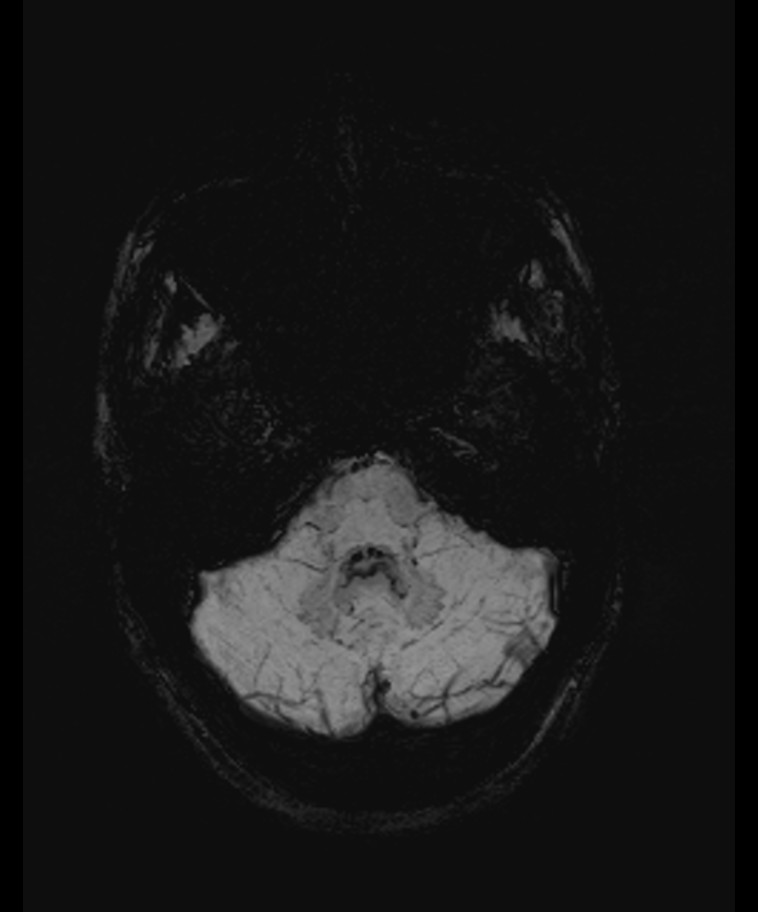 Angiomatous meningioma (Radiopaedia 79459-92579 E 12).jpg