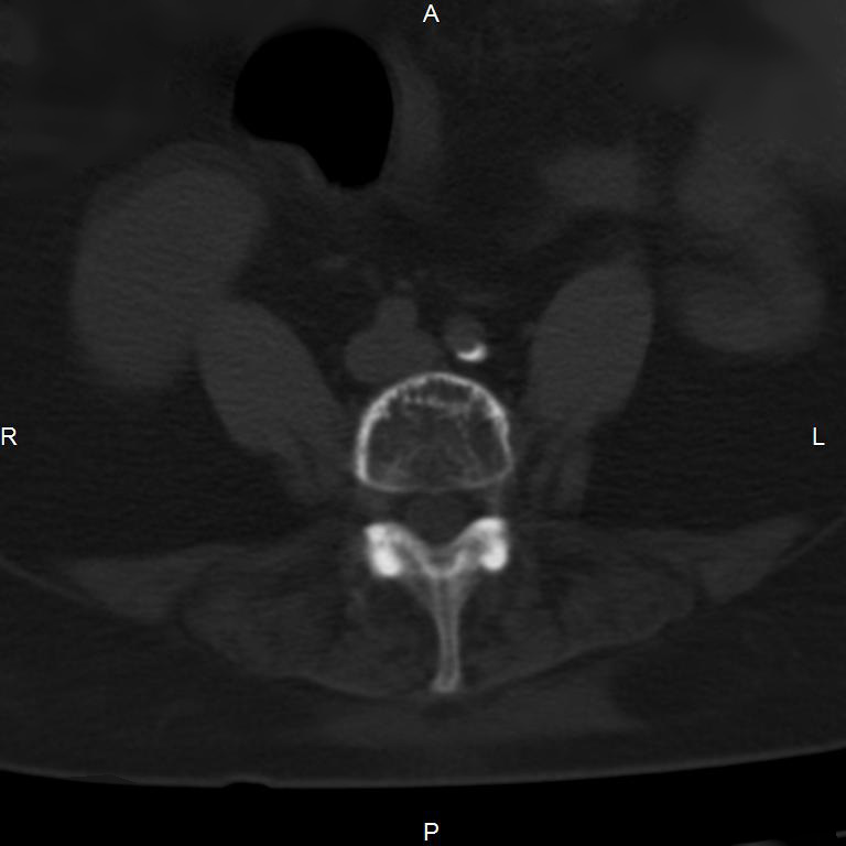Ankylosing spondylitis (Radiopaedia 8748-9556 Axial bone window 40).jpg