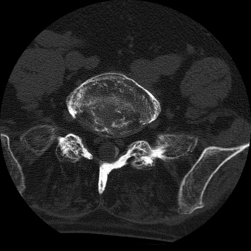 File:Ankylosing spondylitis complicated by fracture-dislocation (Radiopaedia 33583-34674 Axial non-contrast 139).jpg