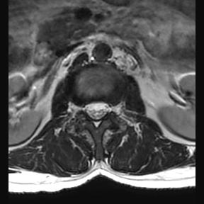 File:Ankylosing spondylitis with zygapophyseal arthritis (Radiopaedia 38433-40516 Axial T2 18).jpg