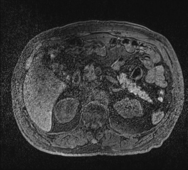 Annular pancreas (Radiopaedia 38292-40320 Axial T1 fat sat 31).png