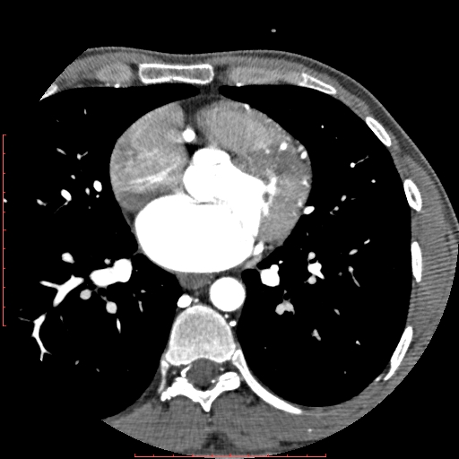 Anomalous left coronary artery from the pulmonary artery (ALCAPA) (Radiopaedia 70148-80181 A 161).jpg