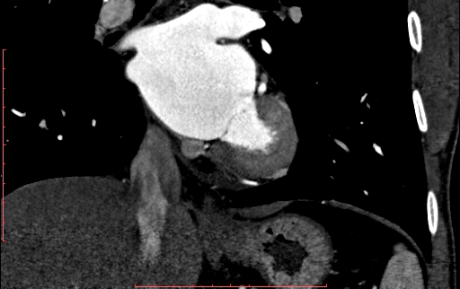 Anomalous left coronary artery from the pulmonary artery (ALCAPA) (Radiopaedia 70148-80181 B 203).jpg