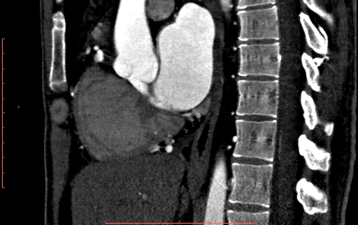 File:Anomalous left coronary artery from the pulmonary artery (ALCAPA) (Radiopaedia 70148-80181 C 108).jpg