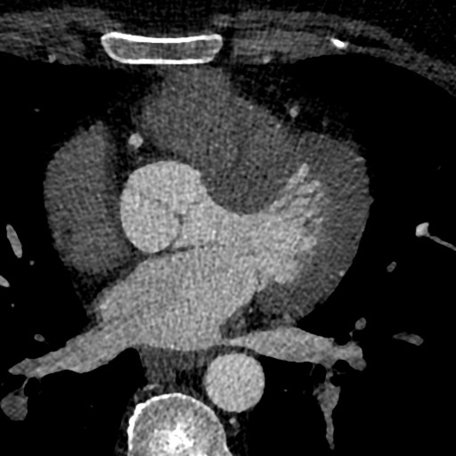File:Anomalous origin of the left coronary artery with malignant course (Radiopaedia 77842-90126 C 104).jpeg