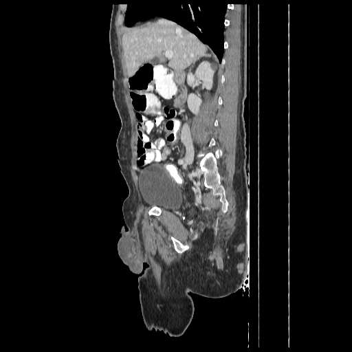 Anorectal carcinoma (Radiopaedia 44413-48064 C 38).jpg