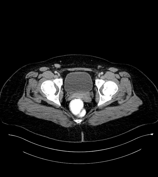 Anterior abdominal wall CSF pseudocyst (CSFoma) (Radiopaedia 79453-92571 A 87).jpg
