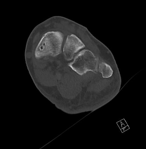 Anterior calcaneal process fracture (Radiopaedia 63353-71943 Axial bone window 83).jpg