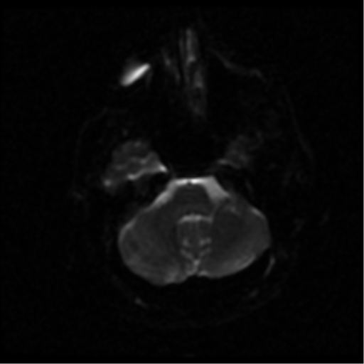 File:Anterior cerebral artery territory infarct (Radiopaedia 39327-41584 Axial DWI 30).png