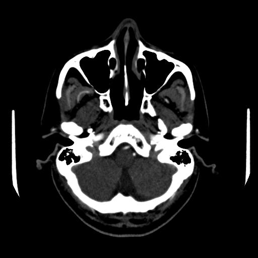 File:Anterior communicating artery aneurysm (Radiopaedia 16633-16335 A 5).jpg