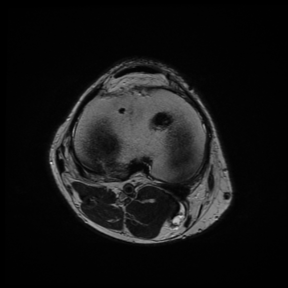File:Anterior cruciate ligament graft tear and bucket-handle tear of medial meniscus (Radiopaedia 75867-87254 Axial T2 8).jpg