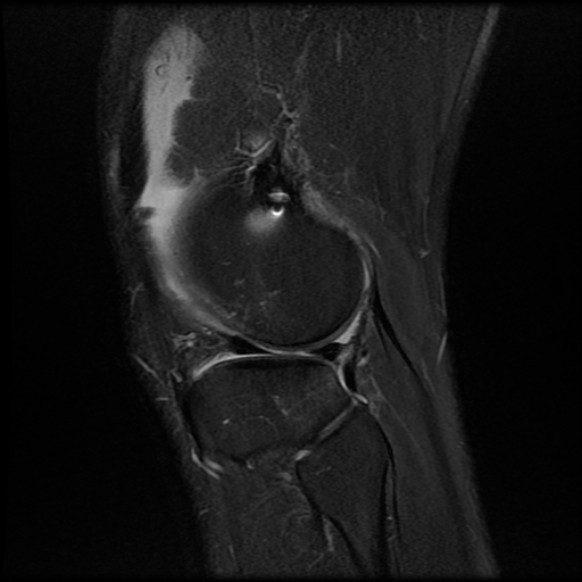 File:Anterior cruciate ligament graft tear and bucket-handle tear of medial meniscus (Radiopaedia 75867-87255 Sagittal PD fat sat 23).jpg