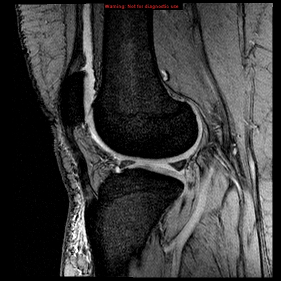 File:Anterior cruciate ligament tear (Radiopaedia 12329-12612 A 7).jpg
