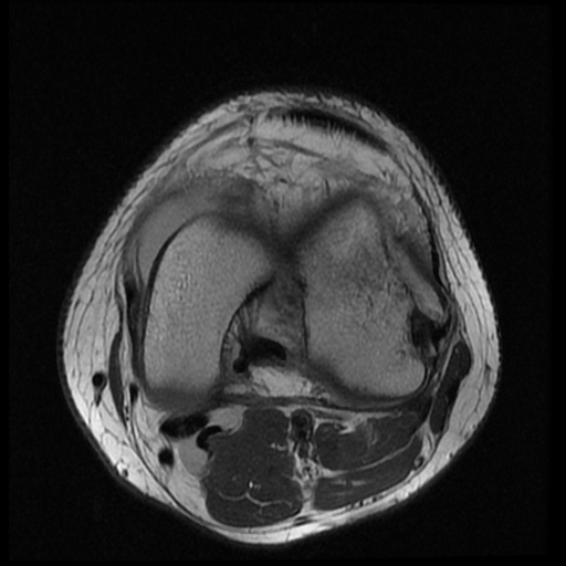 File:Anterior cruciate ligament tear (Radiopaedia 61500-69462 Axial PD 12).jpg
