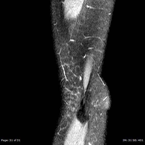 File:Anterior cruciate ligament tear (Radiopaedia 70783-80964 Sagittal STIR 31).jpg