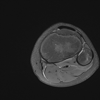 File:Anterior cruciate ligament tear - pediatric (Radiopaedia 62152-70260 Axial PD fat sat 33).jpg