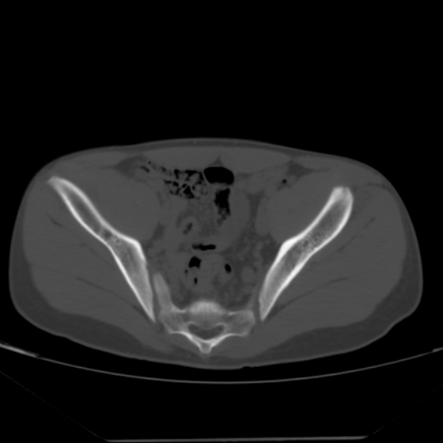 Anterior inferior iliac spine avulsion fracture (Radiopaedia 49469-54627 Axial bone window 22).jpg