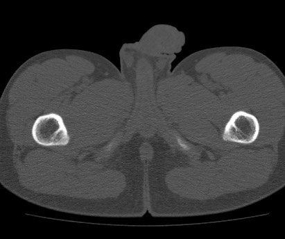 Anterior inferior iliac spine avulsion fracture (Radiopaedia 81312-94999 Axial bone window 75).jpg