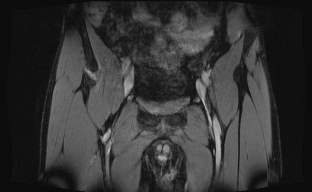 Anterior inferior iliac spine avulsion fracture (Radiopaedia 81312-95000 G 85).jpg