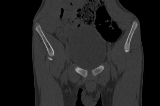 Anterior inferior iliac spine avulsion injury (Radiopaedia 88666-105376 Coronal bone window 18).jpg