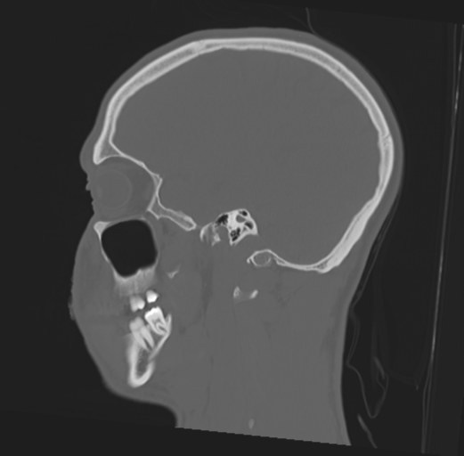 Anterior nasal spine fracture (Radiopaedia 46138-50494 Sagittal bone window 39).png