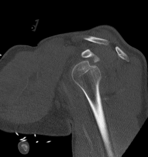 Anterior shoulder dislocation with Hill-Sachs and bony Bankart lesions (Radiopaedia 40424-42974 Sagittal bone window 23).png