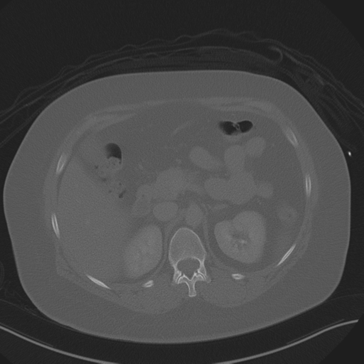 Anterior superior iliac spine avulsion fracture (Radiopaedia 44541-48244 Axial bone window 32).png
