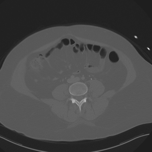 Anterior superior iliac spine avulsion fracture (Radiopaedia 44541-48244 Axial bone window 62).png