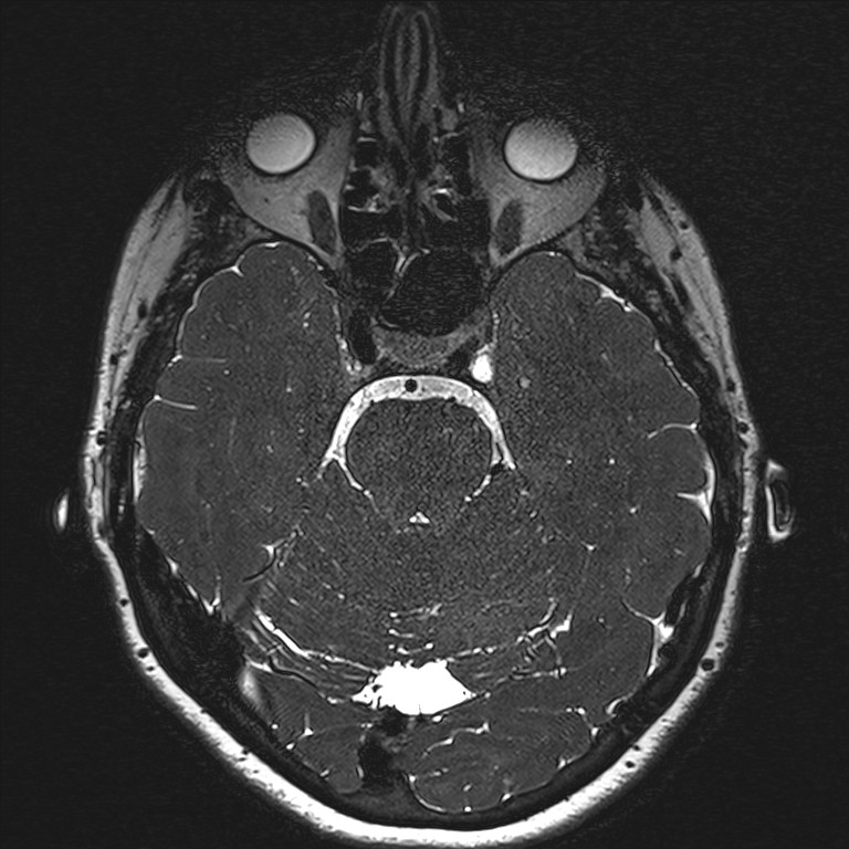 Anterior temporal encephalocele (Radiopaedia 82624-96808 Axial T2 high res 57).jpg