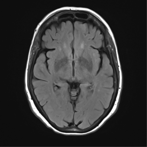 File:Anterior temporal pole cysts (Radiopaedia 46629-51102 Axial FLAIR 13).png