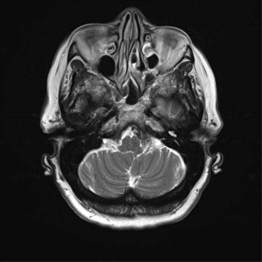 File:Anterior temporal pole cysts (Radiopaedia 46629-51102 C 8).png