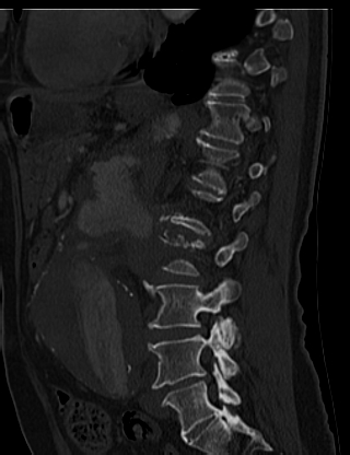 File:Anterior vertebral scalloping (abdominal aortic aneurysm) (Radiopaedia 66744-76067 Sagittal bone window 57).jpg