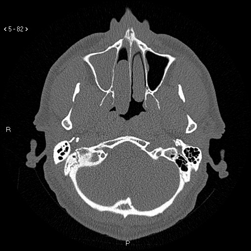 Antrochoanal Polyp (Radiopaedia 70510-80631 Axial bone window 30).jpg