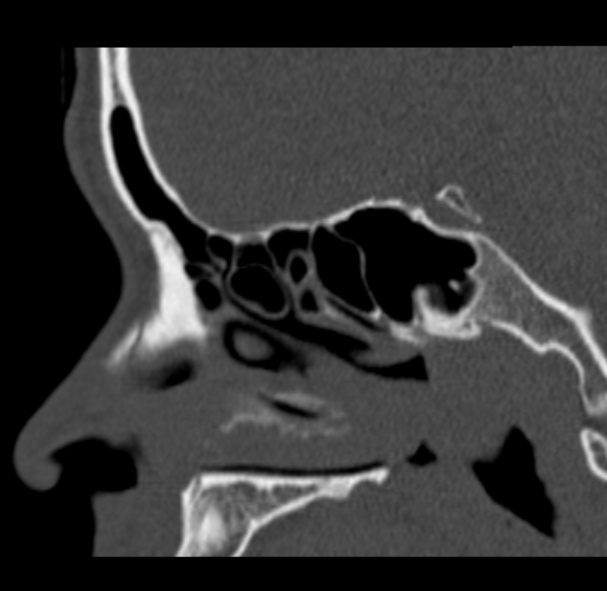 File:Antrochoanal polyp (Radiopaedia 33984-35202 Sagittal bone window 34).jpg