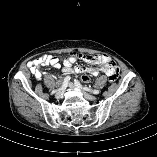Aortic aneurysm and Lemmel syndrome (Radiopaedia 86499-102554 A 60).jpg