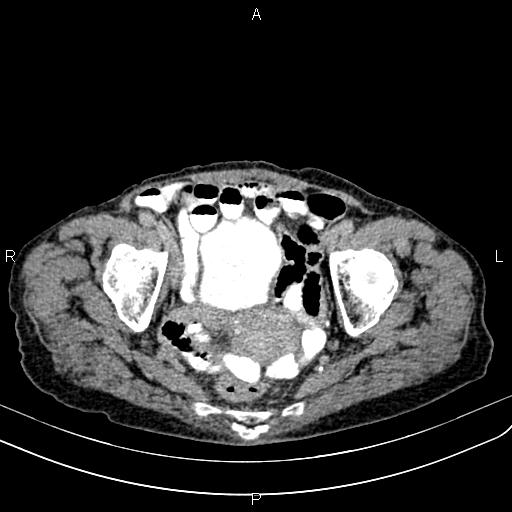 Aortic aneurysm and Lemmel syndrome (Radiopaedia 86499-102554 Axial C+ delayed 69).jpg