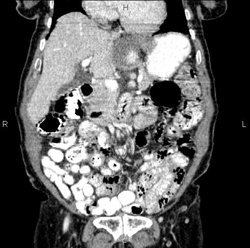 Aortic aneurysm and Lemmel syndrome (Radiopaedia 86499-102554 C 19).jpg