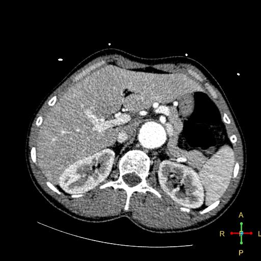File:Aortic aneurysm and penetrating ulcer (Radiopaedia 23590-23704 A 31).jpg