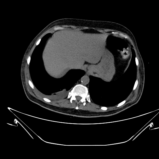 File:Aortic arch aneurysm (Radiopaedia 84109-99365 Axial non-contrast 245).jpg