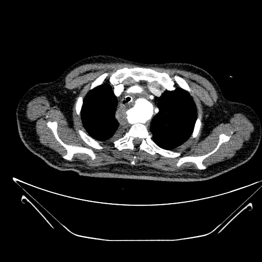 Aortic arch aneurysm (Radiopaedia 84109-99365 B 132).jpg