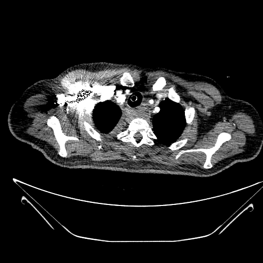 File:Aortic arch aneurysm (Radiopaedia 84109-99365 B 96).jpg