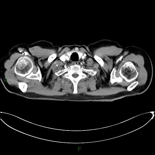 Aortic arch origin of left vertebral artery (Radiopaedia 46327-50737 Axial post contrast 6).jpg