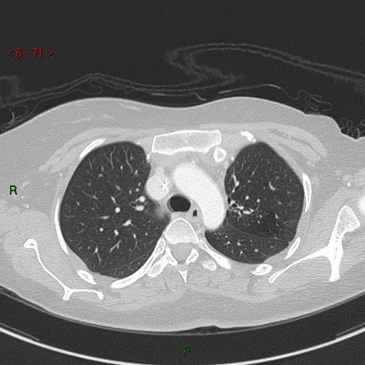 Aortic arch origin of left vertebral artery (Radiopaedia 51520-57286 Axial lung window 71).jpg
