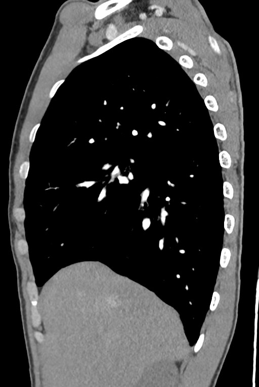 Aortic coarctation with aneurysm (Radiopaedia 74818-85828 B 47).jpg