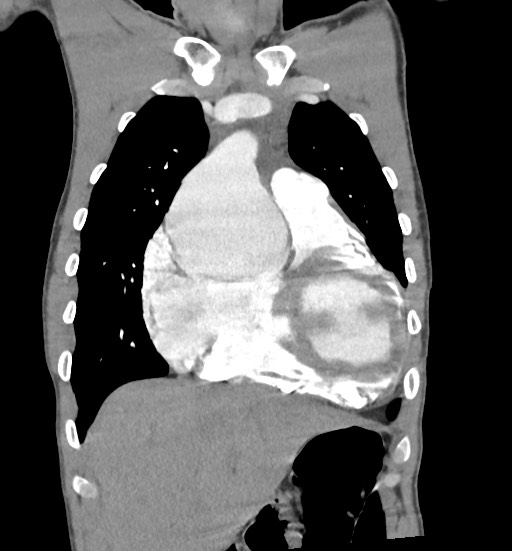 Aortic coarctation with aneurysm (Radiopaedia 74818-85828 C 32).jpg