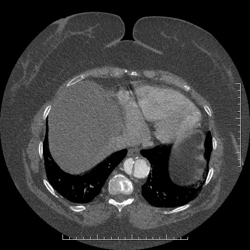 Aortic dissection- Stanford A (Radiopaedia 35729-37268 B 12).jpg