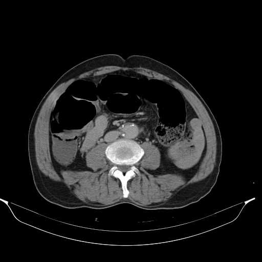 Aortic dissection- Stanford type A (Radiopaedia 22085-22085 Axial C+ delayed 30).jpg