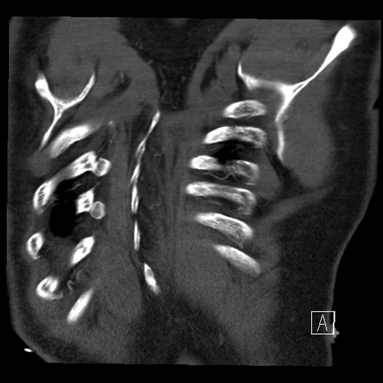 File:Aortic dissection (CTPA) (Radiopaedia 75506-86750 B 69).jpg