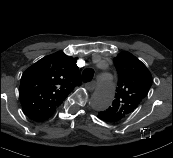 File:Aortic dissection (CTPA) (Radiopaedia 75506-86751 Axial C+ CTPA 37).jpg